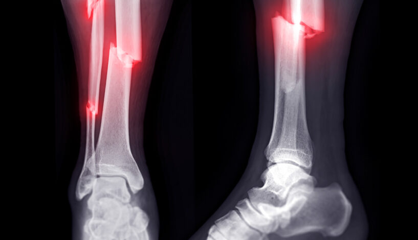 Calcaneal Fracture ORIF - FootEducation