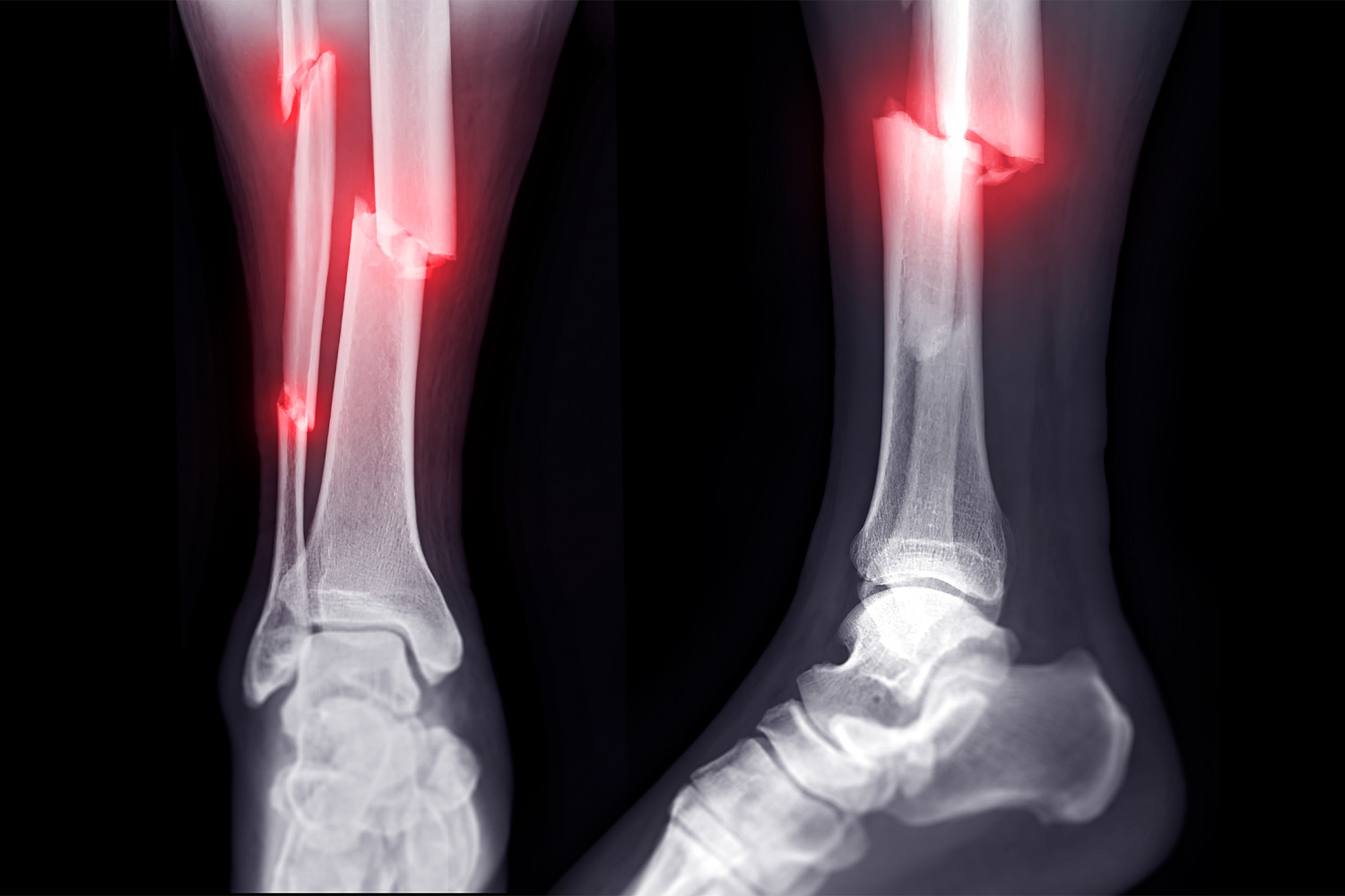 Stress Fractures | Causes, Anatomy Treatment & Prevention