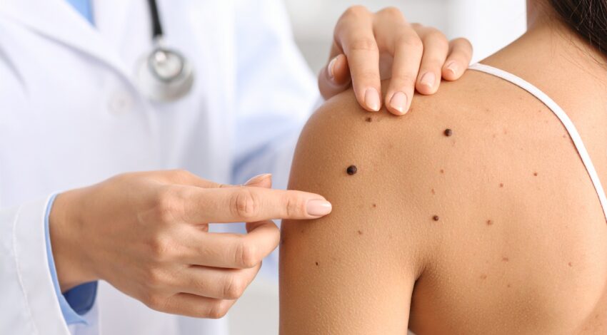 skin check of mole