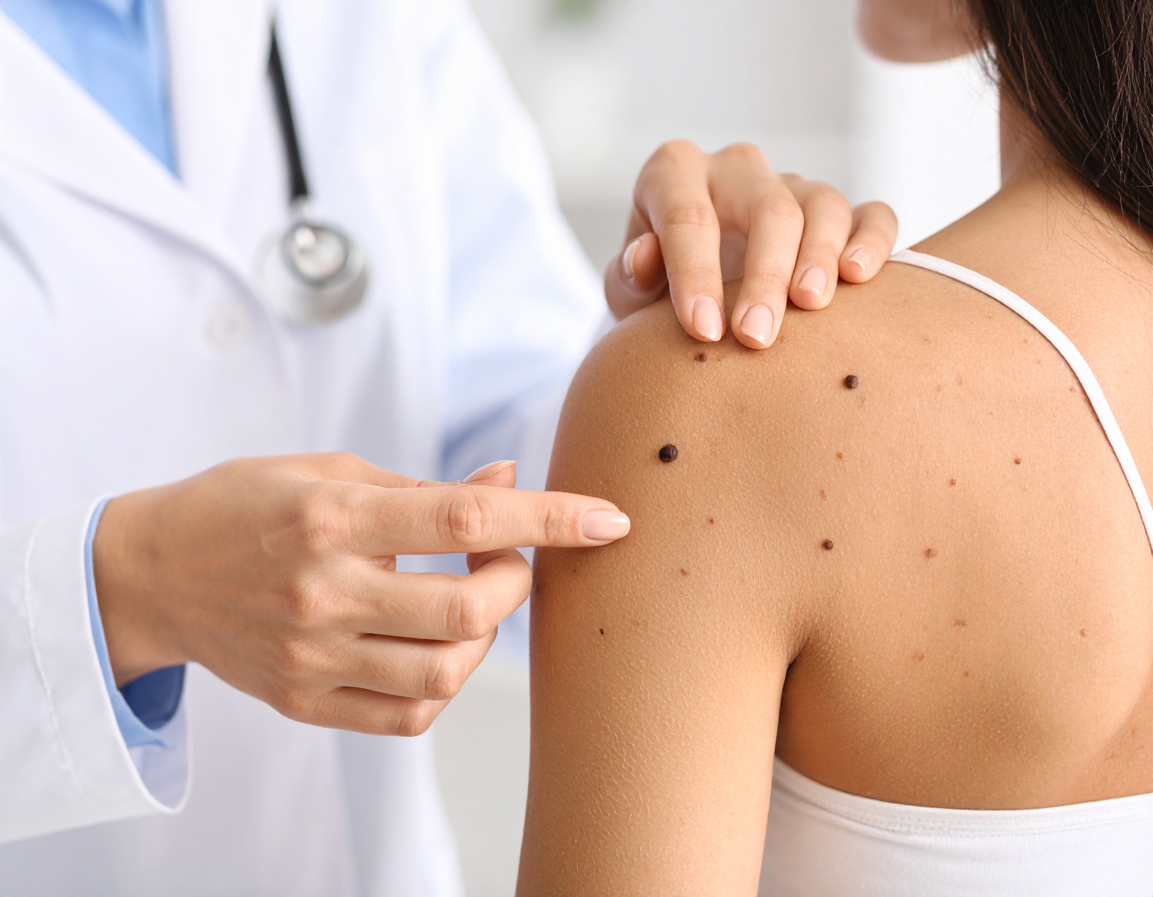 skin check of mole